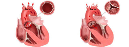 Aortic Valve Stenosis