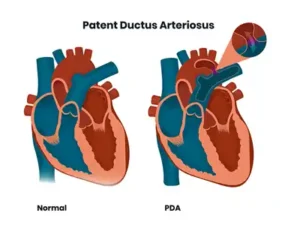 Patent Ductus Arteriosus (PDA)