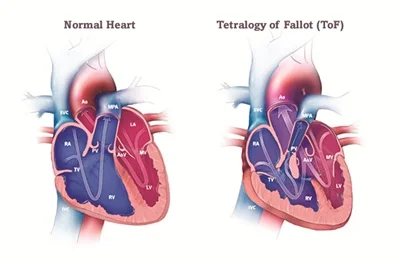 Tetralogy of Fallot (TOF)