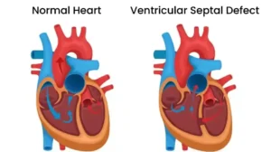Ventricular Septal Defect (VSD)
