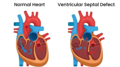 Ventricular Septal Defect (VSD)